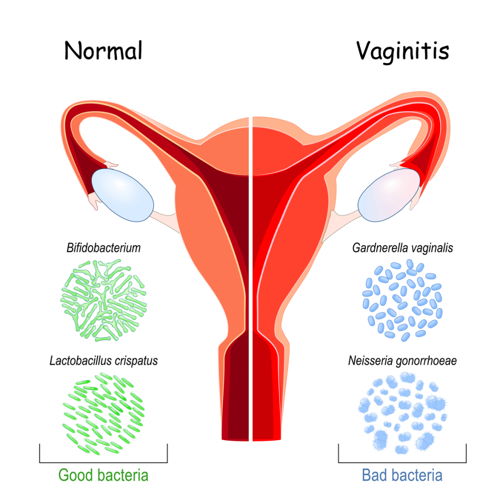 Gardnerella vaginalis inflammation
