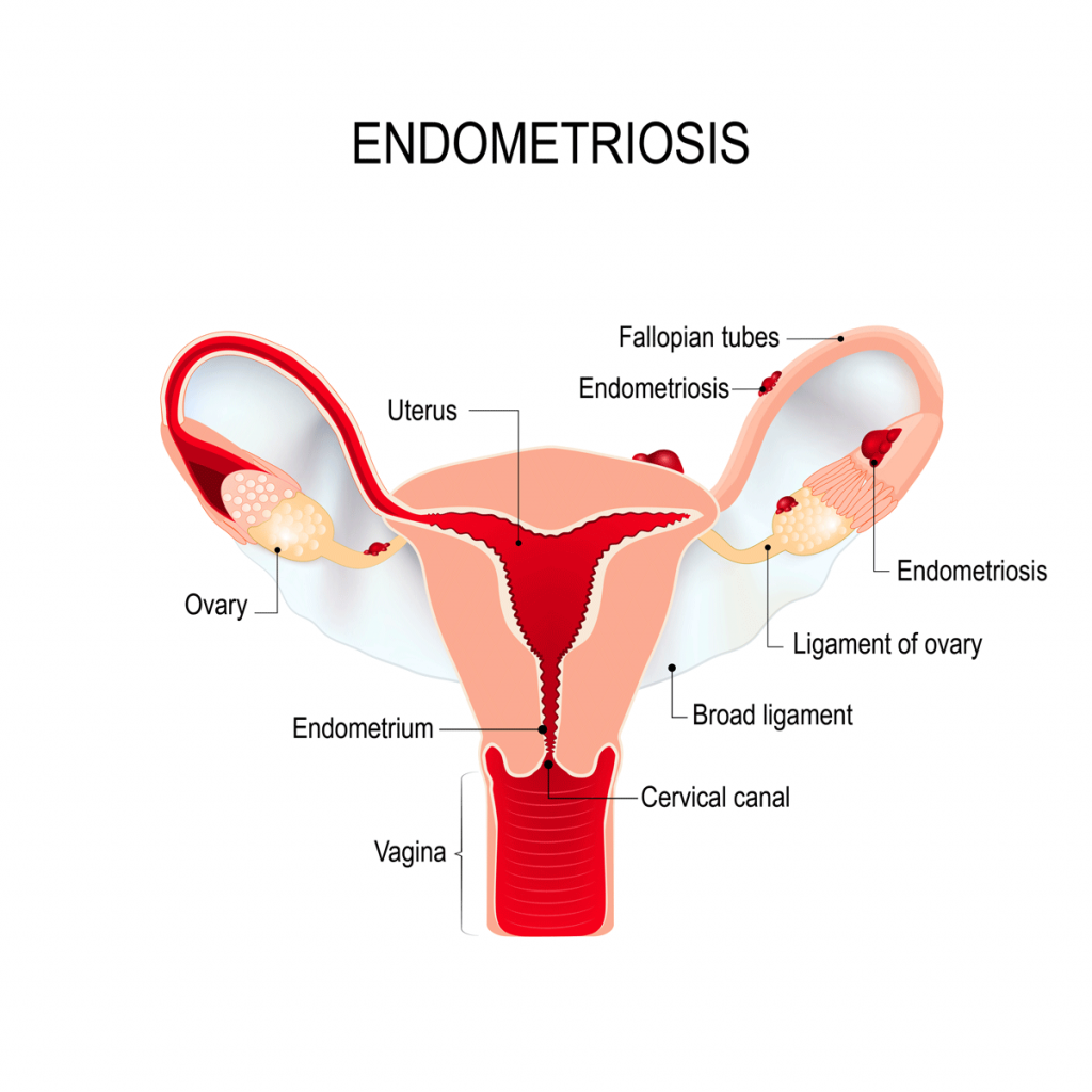 endometriosis diagram