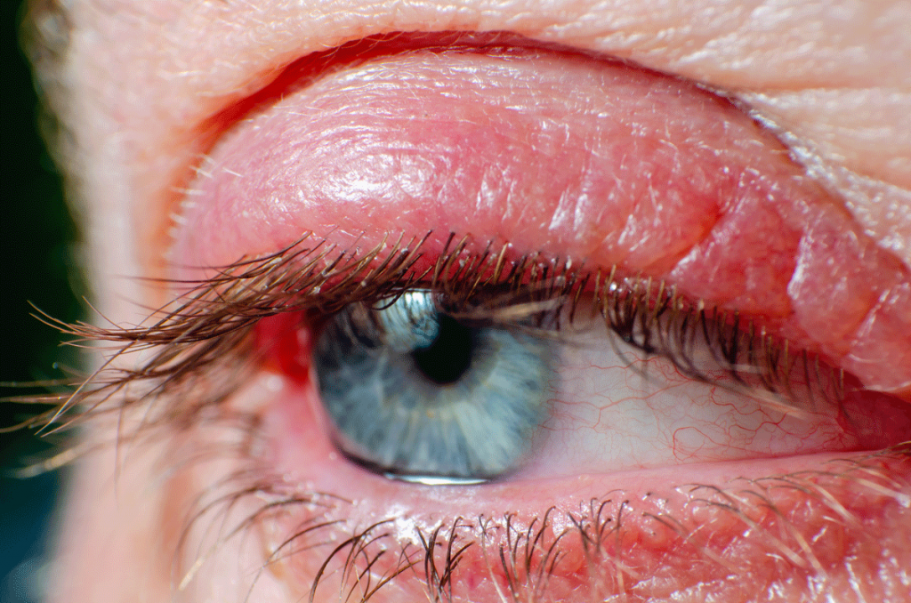 Inflammation of the eye