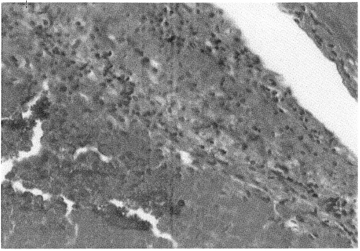 FIG. 7. Implantation locus. Calcification of necrotic hepatonia cells, hemosiderine deposits, and formation of fibrous capsule (hema¬toxylin and eosin [H&N, 240X ).