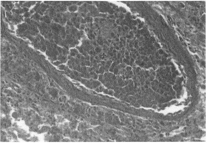 FIG. 5. Rat lung. Arterial vessel with metastatic hepatoma cells emboli (hematoxylin and eosin [H&E], 240X).