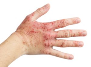 Eczema on a female hand