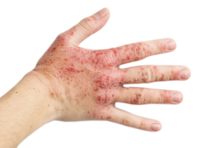 Eczema on a female hand