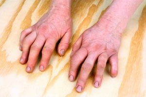 Closeup of woman hands with strong arthritis