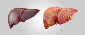illustration of comparsion of healthy and sick cancerous human livers