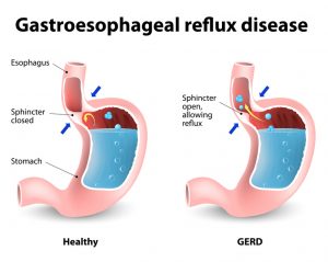 Heartburn and Gastroesophageal Reflux Disease (GERD). The stomach releases strong acids to help break down the food. If the esophageal sphincter opens too often or does not close tight enough, stomach acid can reflux or seep back into the esophagus, damaging it and causing the burning (heartburn).