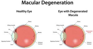 Diagram comparing a healthy eye with one affected by macular degeneration