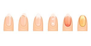 Illustration of fingernails at stages from healthy to fungal infection